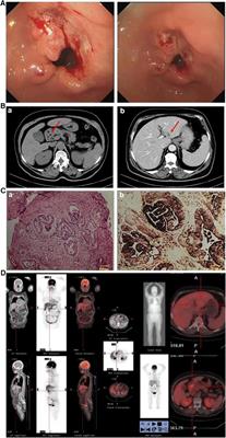 Hepatoid adenocarcinoma of the stomach with metastatic choriocarcinoma of the liver: A case report of a rare subtype of gastric cancer with a complex treatment course